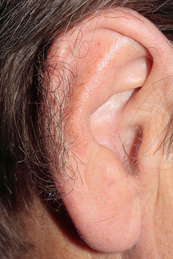 Hypertrichosis (excessive hairiness) of the ear rims Hypertrichosis (excessive hairiness) of the ear rims