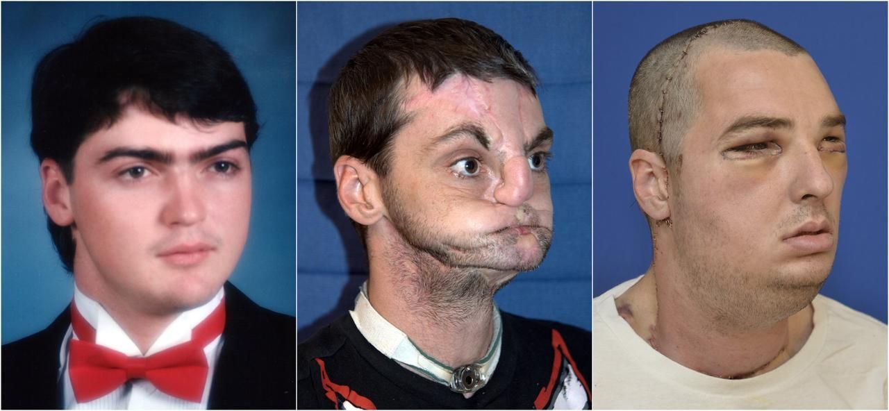 Richard Norris - dosud nejrozsáhlejší transplantace lidského obličeje