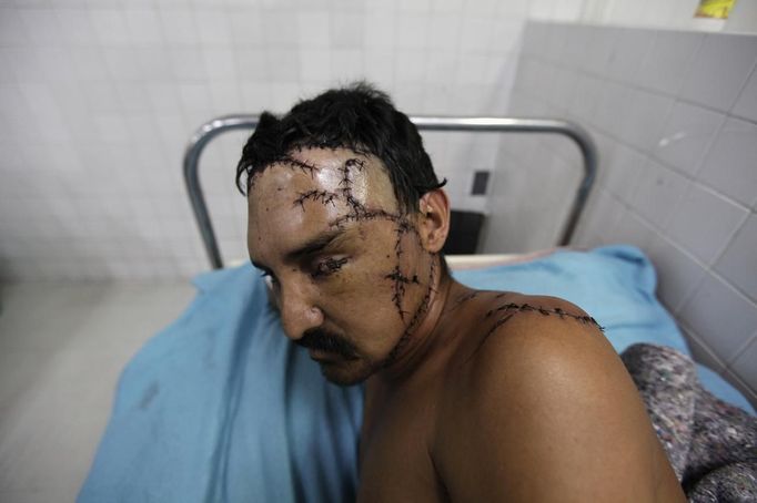 ATTENTION EDITORS - VISUAL COVERAGE OF SCENES OF INJURY OR DEATH A man sits in the emergency room of a local hospital after being treated for a gun shot wound and several cuts with a machete in San Pedro Sula March 27, 2013. San Pedro Sula, the country's second largest city after Tegucigalpa, has a homicide rate of 169 per 100,000 people and was named the world's most violent city for a second year in a row. Lax laws allow civilians to own up to five personal guns. Arms trafficking has flooded the country with nearly 70% illegal firearms. 83.4% of homicides are by firearms, compared to 60% in the United States. Picture taken March 27, 2013. REUTERS/Jorge Cabrera (HONDURAS - Tags: CRIME LAW CIVIL UNREST HEALTH TPX IMAGES OF THE DAY) TEMPLATE OUT. ATTENTION EDITORS: PICTURE 16 OF 39 FOR PACKAGE 'GUN CULTURE - HONDURAS' SEARCH 'HONDURAS GUN' FOR ALL IMAGES Published: Dub. 5, 2013, 11:14 dop.