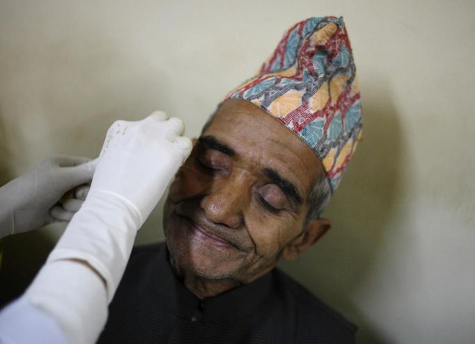 A patient with cataract smiles as a nurse cleans his eye dressings after his cataract surgery at the Tilganga Eye Center in Kathmandu April 27, 2012. About 150,000 of Nepal's 26.6 million people are estimated to be blind in both eyes, most of them with cataracts. Picture taken April 27, 2012. REUTERS/Navesh Chitrakar (NEPAL - Tags: HEALTH SOCIETY POVERTY) Published: Kvě. 2, 2012, 5:24 dop.