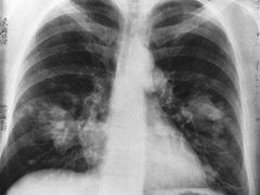 Rakovina plic na rentgenovém snímku.