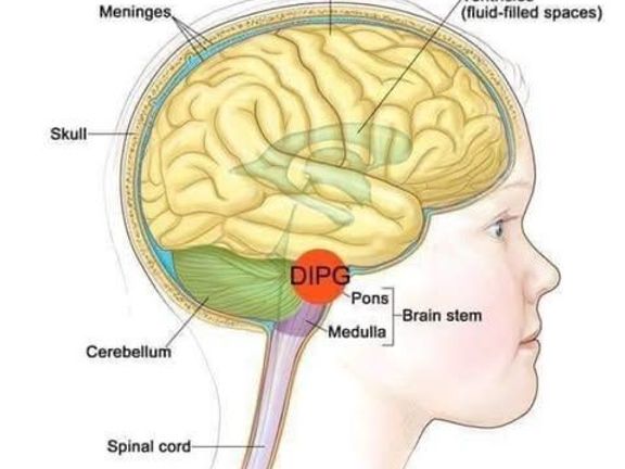 Zabiják v mozku aneb co je DIPG