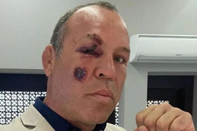 Zraněný bojovník UFC Wanderlei Silva