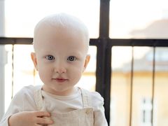 Dvouletý Matěj se narodil s diagnózou albinismu.