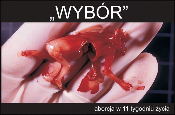 Vyber život - výstava - potrat