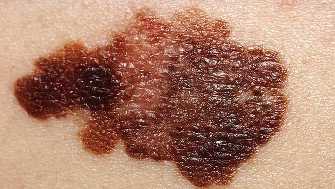 Rakovina kůže patří mezi ty, které často vytvářejí ložiska na dalších místech těla