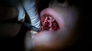 A dentist extracts teeth at the Remote Area Medical (RAM) clinic in Wise, Virginia July 20, 2012. RAM clinics bring free medical, dental and vision care to uninsured and under-insured people across the country and abroad. The Wise clinic was the 647th RAM expedition since 1985 and drew 1700 patients from 14 states, organizers said. Picture taken July 20, 2012. REUTERS/Mark Makela (UNITED STATES - Tags: HEALTH SOCIETY) Published: Čec. 24, 2012, 3:10 odp.