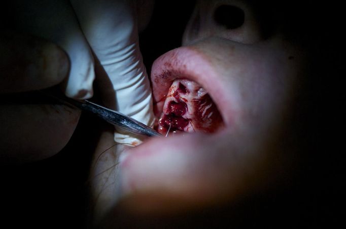 A dentist extracts teeth at the Remote Area Medical (RAM) clinic in Wise, Virginia July 20, 2012. RAM clinics bring free medical, dental and vision care to uninsured and under-insured people across the country and abroad. The Wise clinic was the 647th RAM expedition since 1985 and drew 1700 patients from 14 states, organizers said. Picture taken July 20, 2012. REUTERS/Mark Makela (UNITED STATES - Tags: HEALTH SOCIETY) Published: Čec. 24, 2012, 3:10 odp.