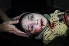 Vítězný snímek švédského fotografa Niclase Hammarströma ukazuje tvář jedenáctileté Danii, kterou zranil šrapnel, když si hrála na ulici syrského Aleppa.