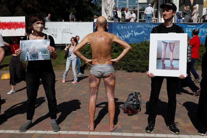 Artem Pronin se účastní demonstrace proti policejnímu násilí. Na předchozích protestech byl podle svých slov zadržený a zraněný, modřiny a podlitiny teď ukazuje.