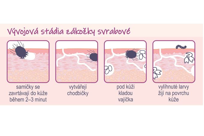Na ilustraci je zobrazen vývojový cyklus zákožky svrabové (Sarcoptes scabiei) ve čtyřech krocích.