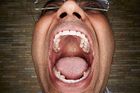 Vijay Kumar z Indie si vysloužil zápis do knihy rekordů svými doslova plnými ústy. V puse má totiž nejvíce zubů ze všech, a to rovnou 37. Běžně má dospělý člověk jen 32 zubů, často i méně.
