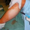Injekce buněčné suspenze do lýtkového svalu na chirurgickém sále