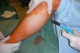 Injekce buněčné suspenze do lýtkového svalu na chirurgickém sále.