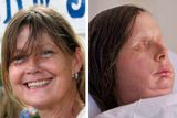 Američanka Charla Nashová, které vloni transplantoval tvář tým českého chirurga Bohdana Pomahače. Žena přišla o ruce, nos, rty i oči kvůli útoku šimpanze.