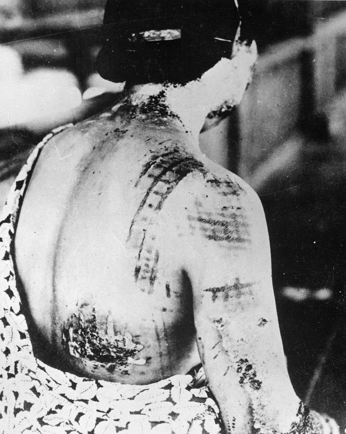 Celkový počet obětí výbuchu atomové bomby v Hirošimě se odhaduje až na 140 tisíc lidí, mnozí podlehli nemoci z ozáření, popáleninám.
