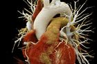 CT angiografie srdce a hrudní aorty, pohled zpředu.