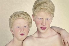 FOTO Krása na okraji společnosti: Jak se žije albínům?
