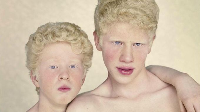 Gustavo Lacerda fotil lidi trpící albinismem