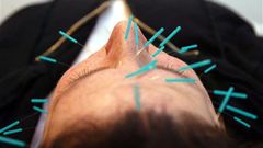 Akupunktura - ilustrační foto