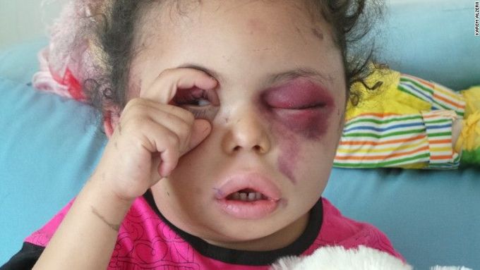 Zraněná holčička Buthaina Muhammad Mansour al-Raimi z Jemenu.