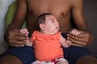 Brazilci našli virus zika v mozku dětí postižených mikrocefalií