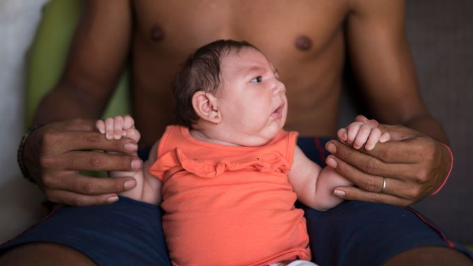 Luiza se narodila v Brazílii s poruchou zvanou mikrocefalie. Nemoc souvisí s nakažením její matky virem Zika po komářím kousnutí.