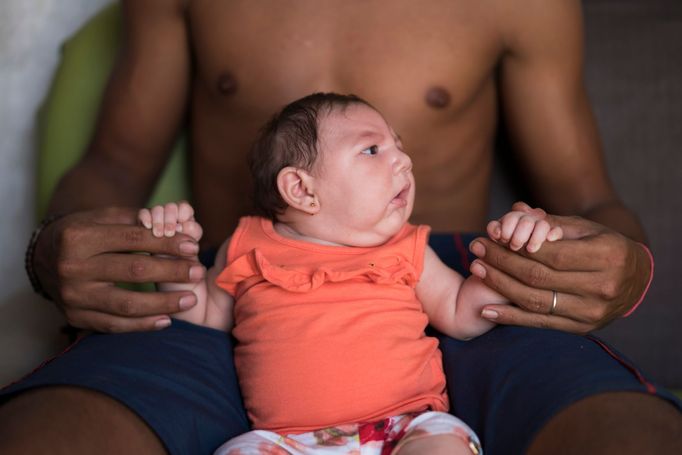 Luiza se narodila v Brazílii s poruchou zvanou mikrocefalie. Nemoc souvisí s nakažením její matky virem Zika po komářím kousnutí.