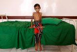 Khaled Abdullah / únor 2019: Dvanáctiletá Fatima Ibrahim Hadiová sedí na nemocniční posteli v jemenském městě Aslam. Dívka je obětí hladomoru v Jemenu - trpí podvýživou a váží jen 10 kg.