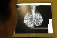 Rakovina prsu ohrožuje i muže, v Česku jich onemocní 60 ročně, varují lékaři