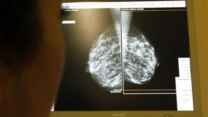 Rakovinu prsu lze odhalit vyšetřením na mamografu.