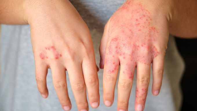 S atopickým ekzémem jsou spojené i psychické problémy.