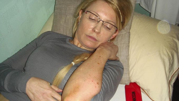 Tymošenková ukázala v pátek modřiny, které ji měli způsobit dozorci