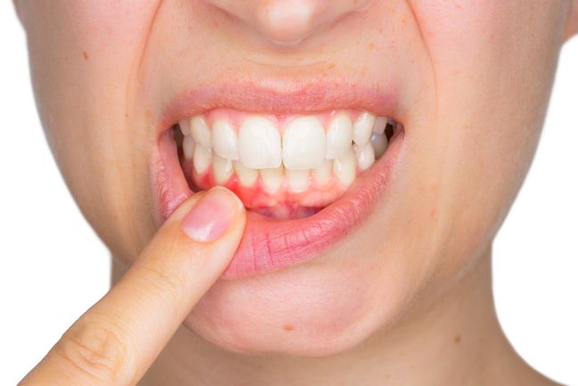 Za zkažené zuby může genetika