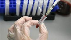 Testování vzorku HIV/AIDS