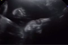 Nenarozené dítě se během ultrazvuku usmálo na své rodiče a zamávalo jim