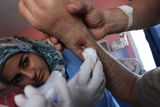 Proto jsou turecké polní nemocnice pro mnohé uprchlíky jedinou záchranou. Na snímku: Turecký lékař kontroluje ránu u ženy, která v Sýrii utrpěla průstřel paže.