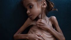 Hladovějící jemenská dívka Amal Hussejnová