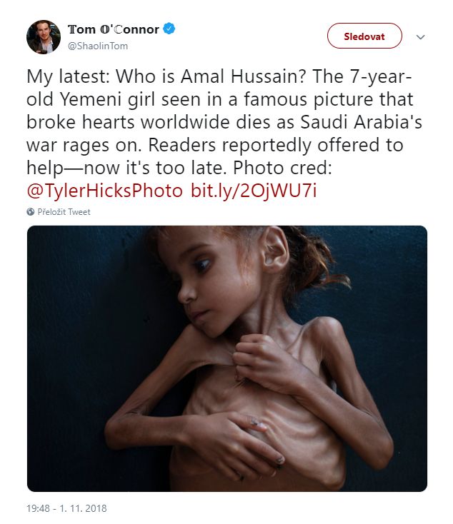 Hladovějící jemenská dívka Amal Hussejnová