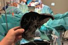 Unikátní operací zachránil malého chlapce. Orgán mu “dorostl” a teď už je dvojnásobný