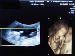 Čtyřrozměrný ultrazvuk pomáhá určit vývojové vady plodu.
