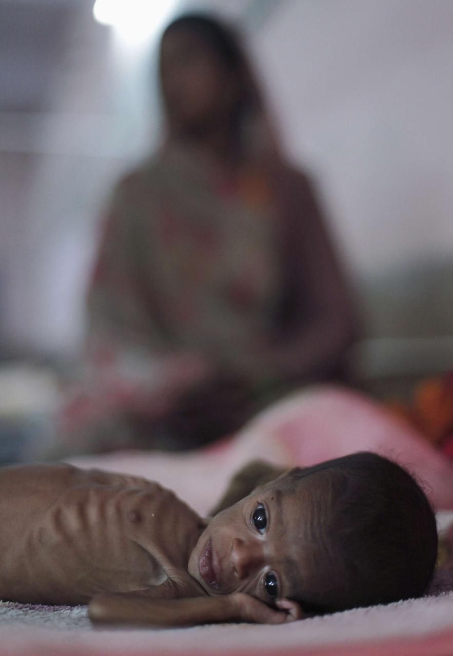 Podvyživené děti v Indii