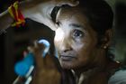 Foto: Jak se v Indii zbavit šedého zákalu? Chudí lidé musí spoléhat na pomoc zdarma