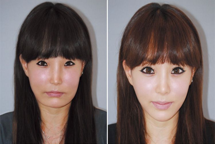 Plastické operace v Jižní Korey