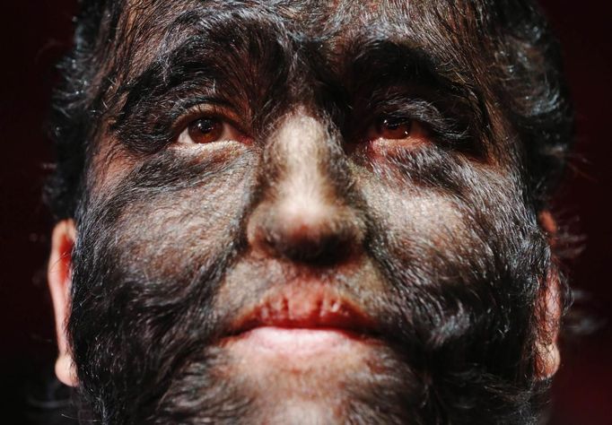 Performer Jesus Aceves (also known as Chuy), who has hypertrichosis, which is a skin condition where an abnormal amount of hair growth is present on the body, poses before a rehearsal for the Circus of Horrors at the Churchill Theatre in Bromley, south east London January 10, 2013. Circus of Horrors, former finalists on television program "Britain's Got Talent", have advertised for a wolf man or woman on government jobs website Directgov. The circus have a Mexican wolf man (who is Aceves), but new UK Border Agency rules meant that before a worker can be granted a certificate of sponsorship, the company must advertise the job in Britain. Picture taken January 10, 2013. REUTERS/Luke MacGregor (BRITAIN - Tags: ENTERTAINMENT HEADSHOT HEALTH SOCIETY IMMIGRATION BUSINESS EMPLOYMENT) Published: Led. 11, 2013, 10:08 dop.