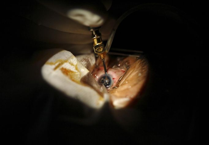 Surgeon Sanduk Ruit operates on the eye of a patient to remove her cataracts at the Tilganga Eye Center in Kathmandu April 25, 2012. Ruit, a Nepali national at the Tilganga Eye Centre, pioneered a simple eye operation benefiting tens of thousands of people in Nepal and other countries in Asia and Africa, where surgical teams from the centre provide much needed care in field camps. Picture taken April 25, 2012. REUTERS/Navesh Chitrakar (NEPAL - Tags: HEALTH SOCIETY POVERTY) Published: Kvě. 2, 2012, 5:31 dop.