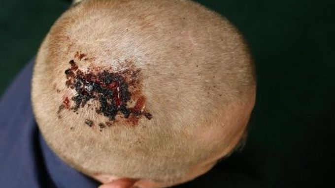 Zraněný fanoušek Manchesteru United po zápase s římským AS.