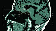 Mozek, mozkový nádor, ilustrační foto