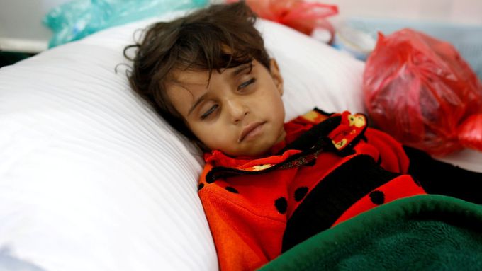 Malá dívka v jemenském Saná nakažená cholerou.