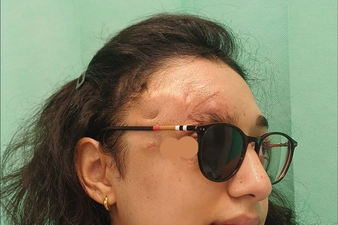 Pacientka Prabhjot Juttlová s poraněním oka.